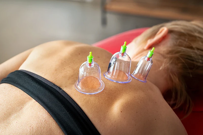 Can Ladies Do Cupping?