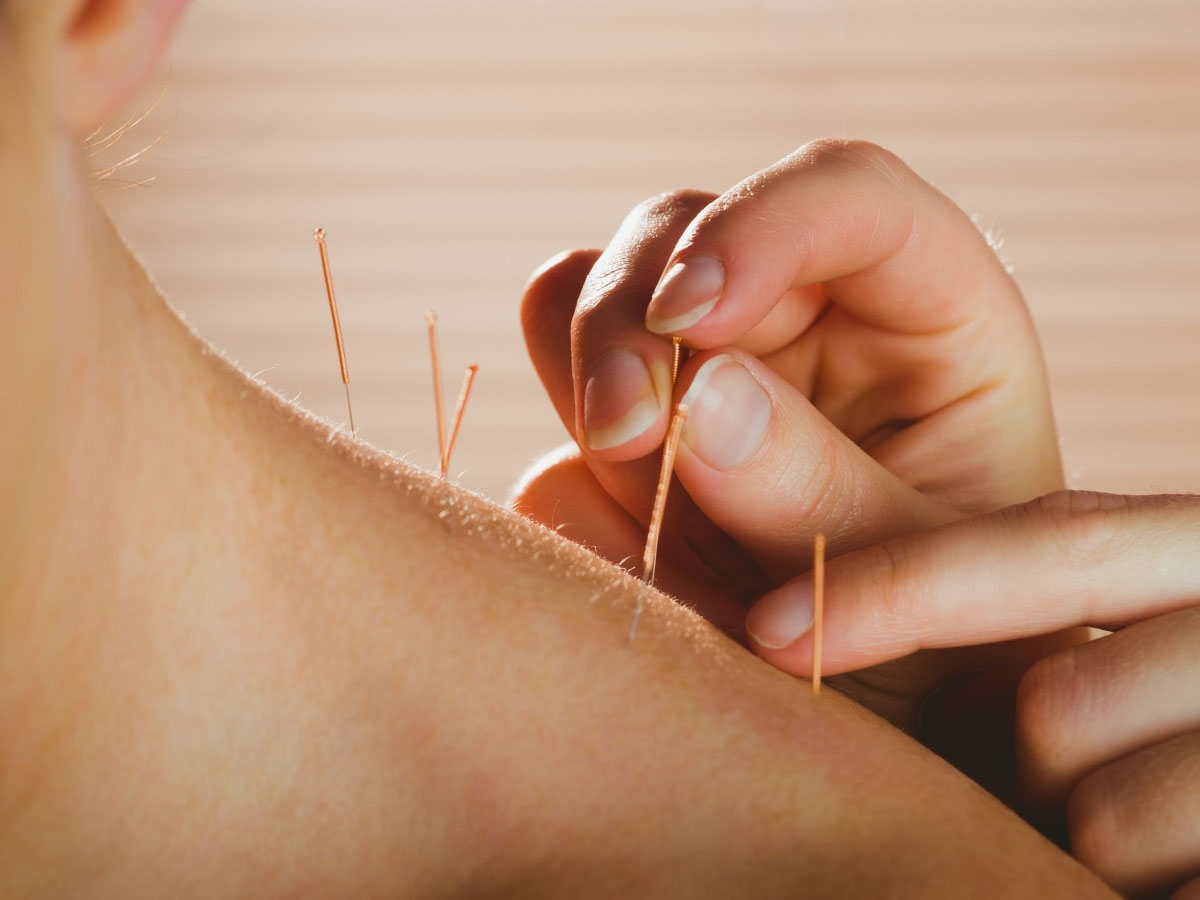 Dry Needling, Cupping and Acupuncture; What are the Differences