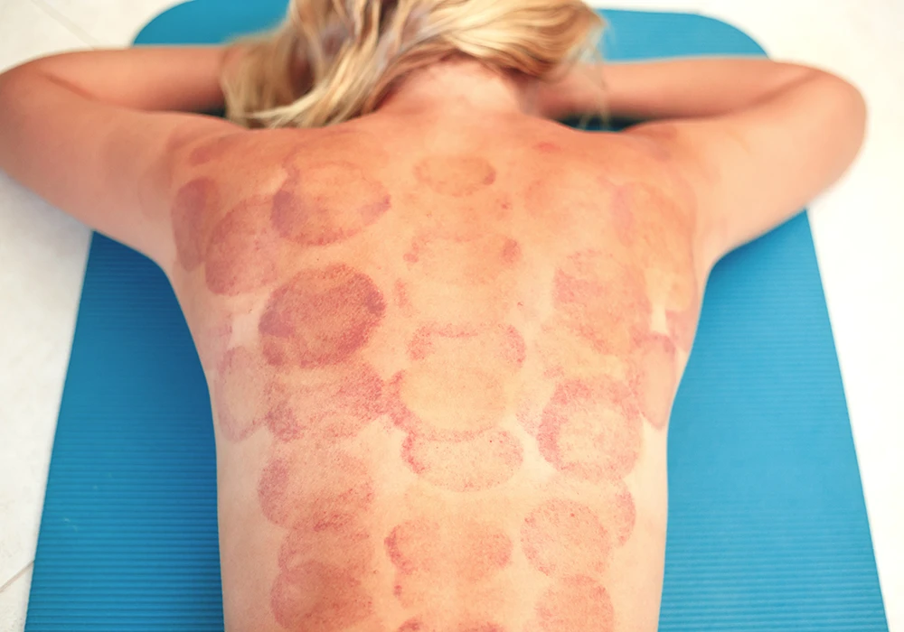 Do Cupping Marks Get Worse?