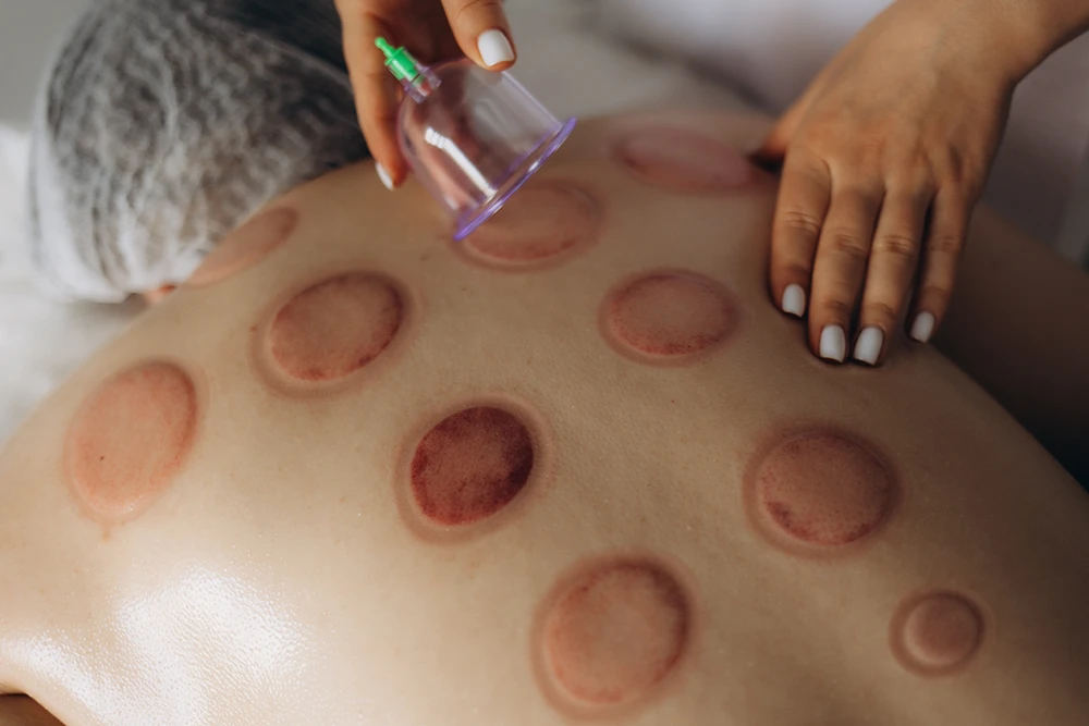 How to Heal Cupping Bruises?