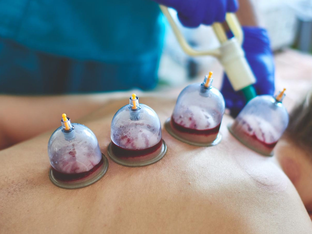 What are the Benefits of Cupping Therapy on Your Chest