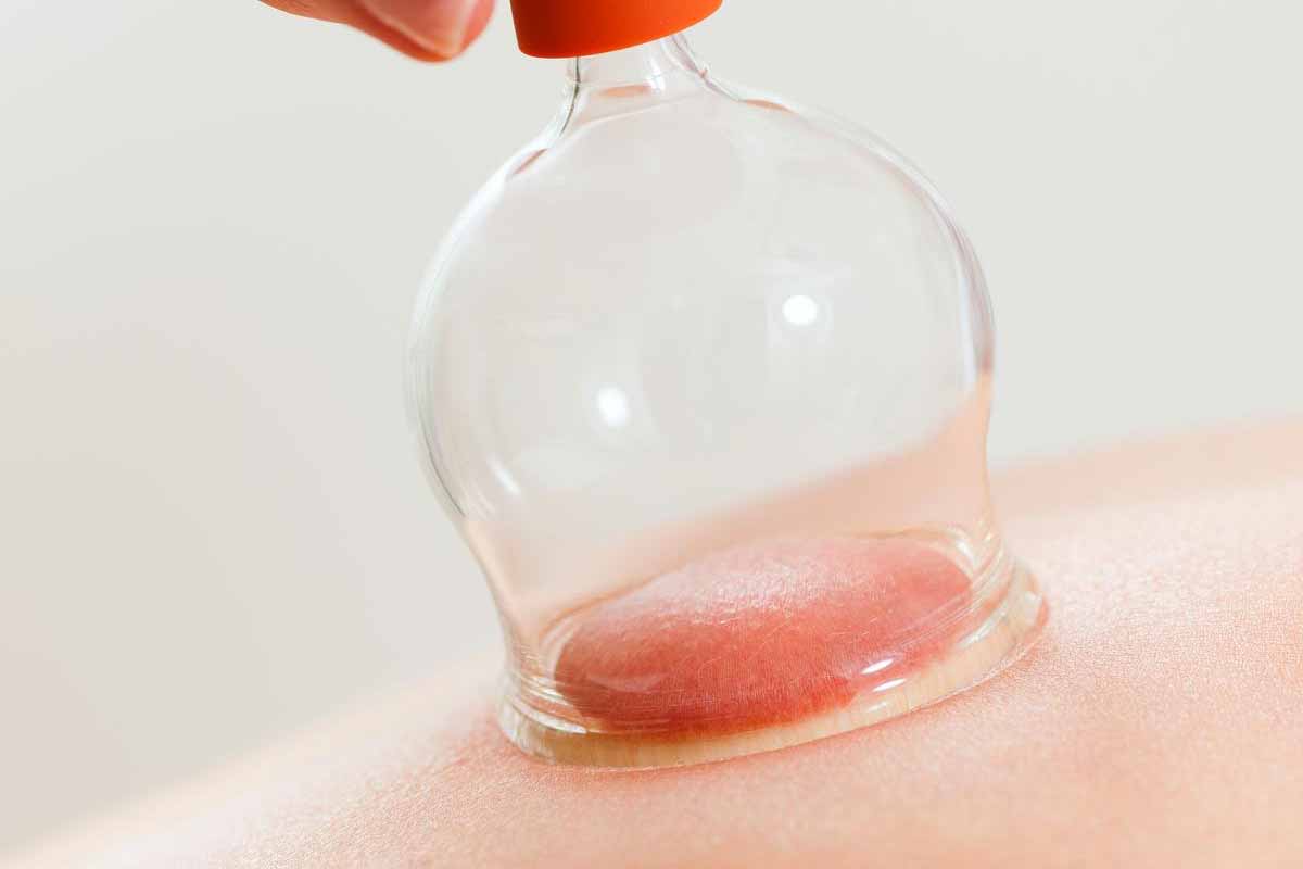Cupping Therapy in Las Vegas