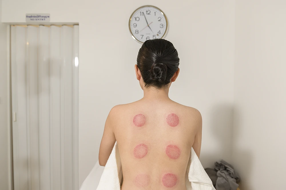 How Long Should You Wait Between Cupping Sessions?