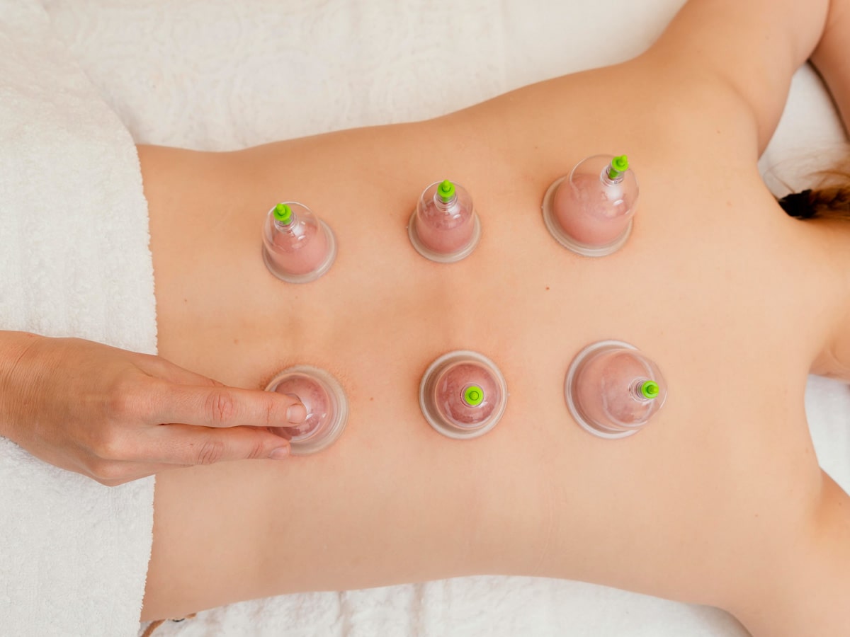 How Often Can I Do Cupping Therapy?