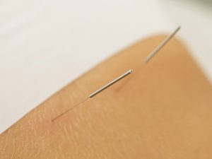What Happens When Dry Needling Hits a Nerve?