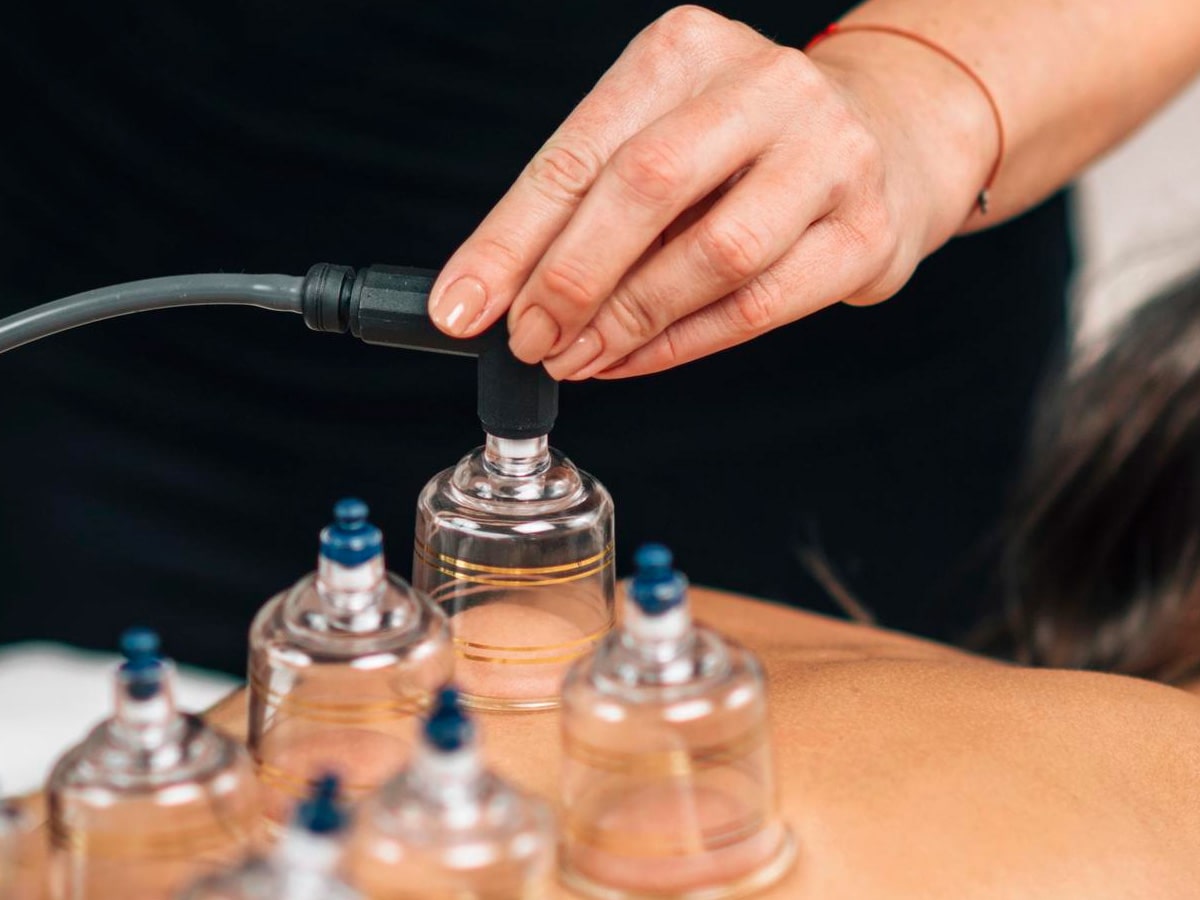 Cupping and Massage Therapy What are the Differences?