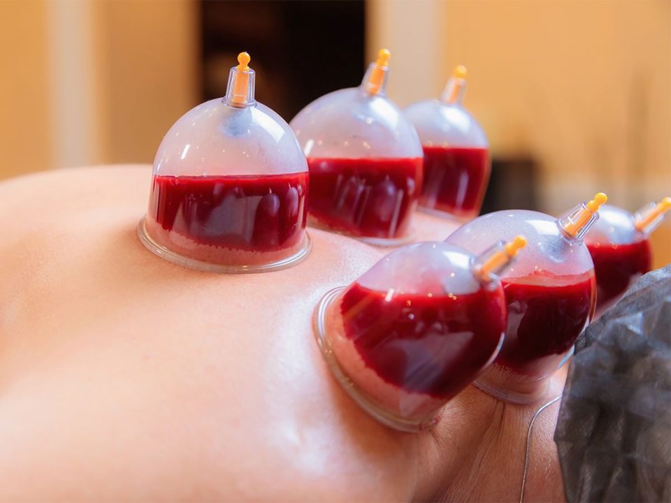 Can Cupping Therapy Cause Blood Clots?