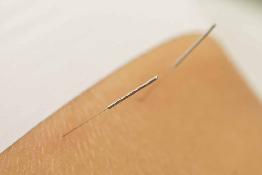 Dry Needling Henderson, NV