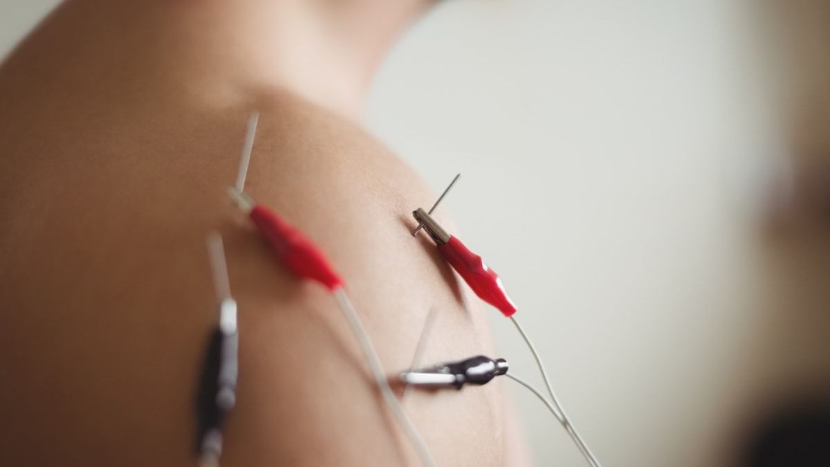 What to Expect at Your First Dry Needling Session for Muscle Knots