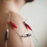 What to Expect at Your First Dry Needling Session for Muscle Knots