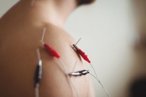 What to Expect at Your First Dry Needling Session for Muscle Knots