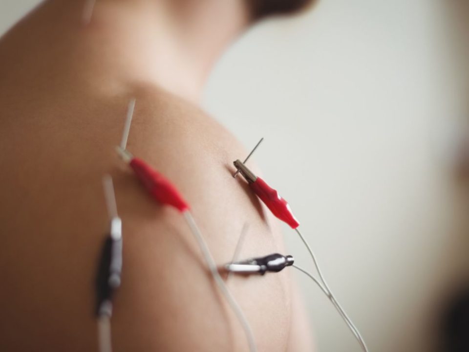 What to Expect at Your First Dry Needling Session for Muscle Knots